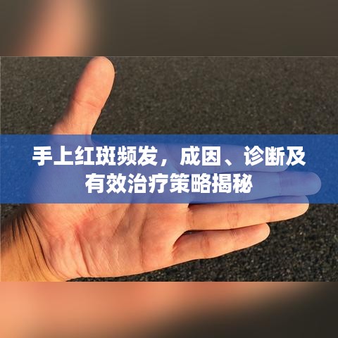 手上紅斑頻發(fā)，成因、診斷及有效治療策略揭秘