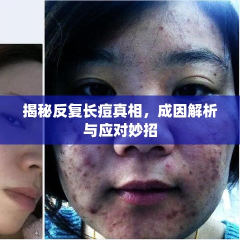 揭秘反復(fù)長痘真相，成因解析與應(yīng)對妙招