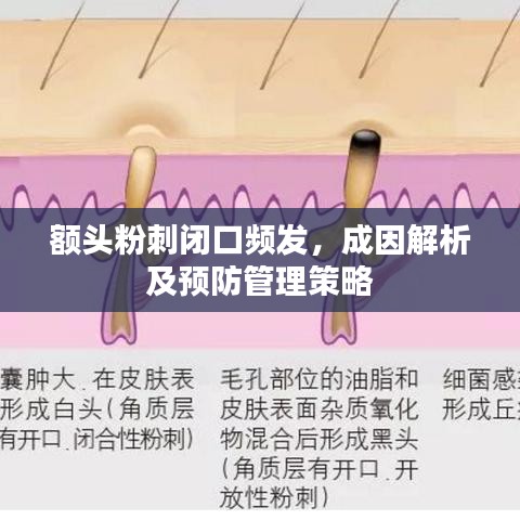 額頭粉刺閉口頻發(fā)，成因解析及預(yù)防管理策略